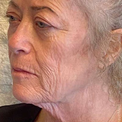 Junera Before & After Gallery - Patient 553806 - Image 1