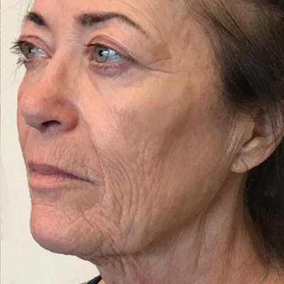 Junera Before & After Gallery - Patient 553806 - Image 2