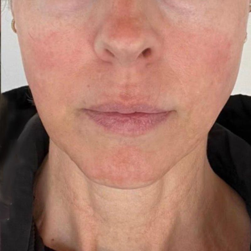 Junera Before & After Gallery - Patient 217384 - Image 2