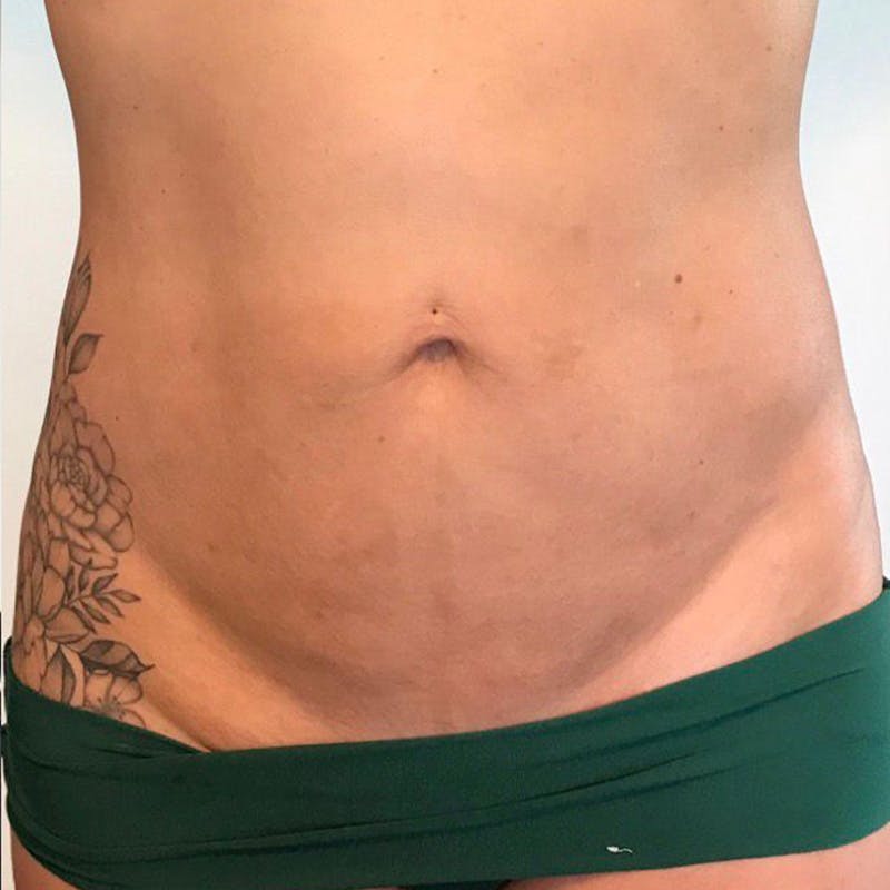 Junera Before & After Gallery - Patient 835097 - Image 2