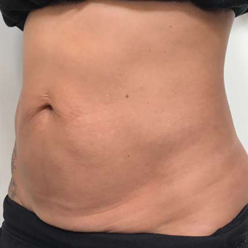Junera Before & After Gallery - Patient 835097 - Image 3