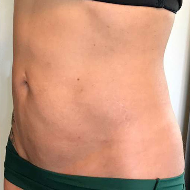 Junera Before & After Gallery - Patient 835097 - Image 4
