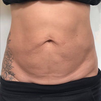 Junera Before & After Gallery - Patient 835097 - Image 1