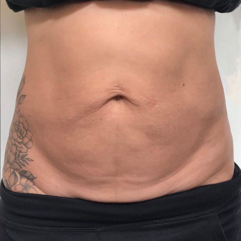 Junera Before & After Gallery - Patient 835097 - Image 1