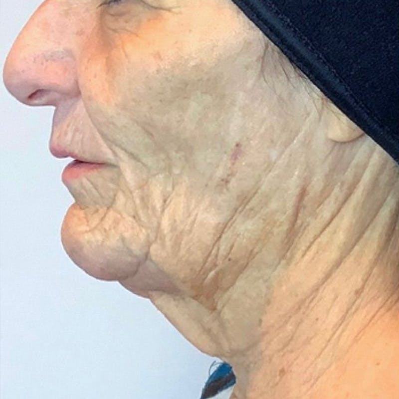 Junera Before & After Gallery - Patient 410359 - Image 1