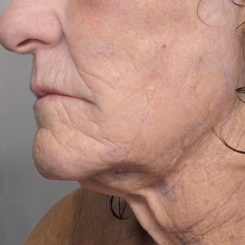 Junera Before & After Gallery - Patient 410359 - Image 2