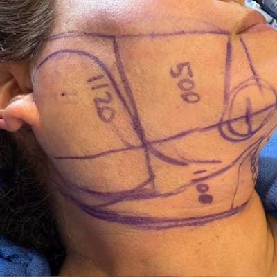 Junera Before & After Gallery - Patient 233409 - Image 1