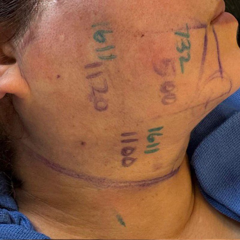 Junera Before & After Gallery - Patient 233409 - Image 2