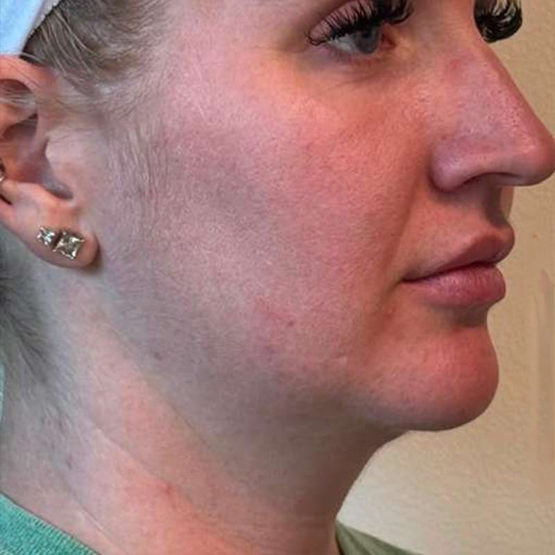 Junera Before & After Gallery - Patient 188651 - Image 3