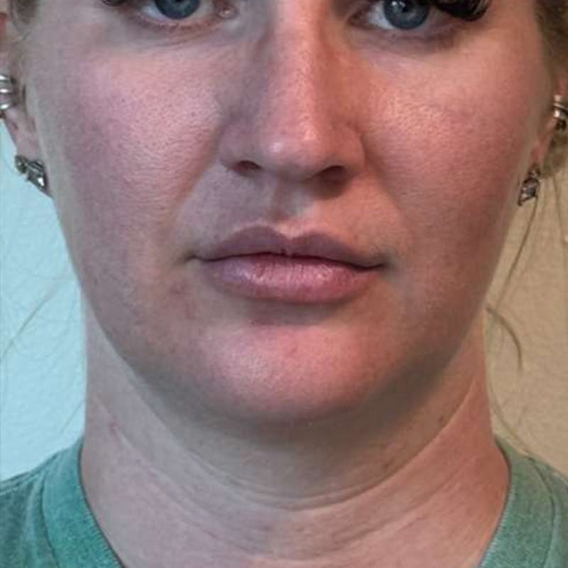 Junera Before & After Gallery - Patient 188651 - Image 1