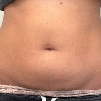 Junera Before & After Gallery - Patient 273254 - Image 1
