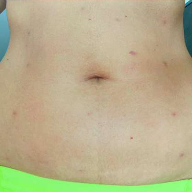 Junera Before & After Gallery - Patient 273254 - Image 2