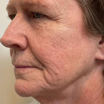 Junera Before & After Gallery - Patient 502283 - Image 1
