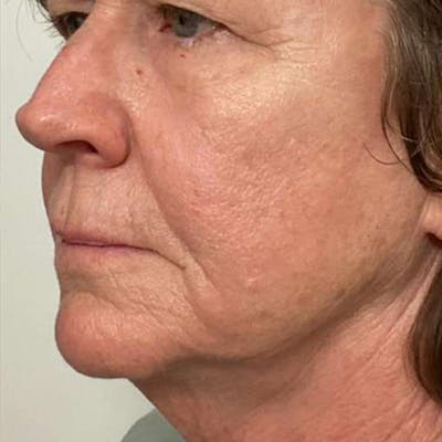 Junera Before & After Gallery - Patient 502283 - Image 2