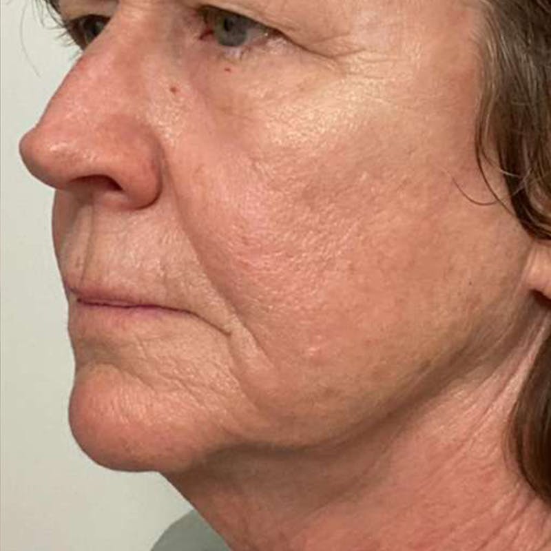 Junera Before & After Gallery - Patient 502283 - Image 2