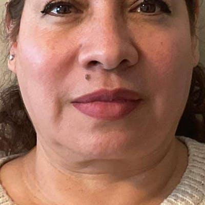 Junera Before & After Gallery - Patient 204131 - Image 1