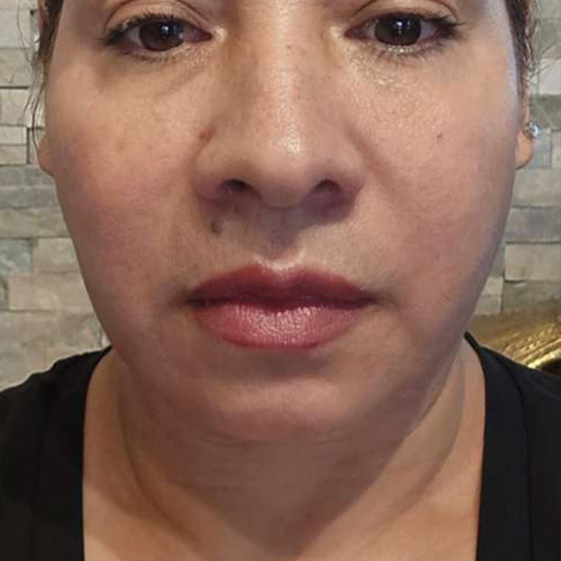 Junera Before & After Gallery - Patient 204131 - Image 2