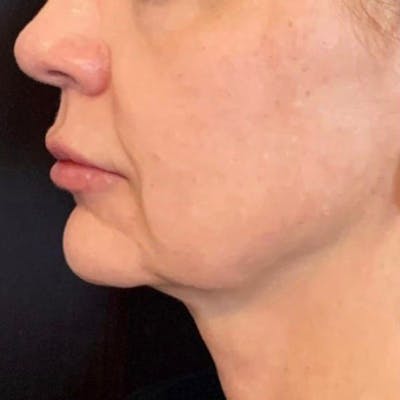 Junera Before & After Gallery - Patient 395201 - Image 1