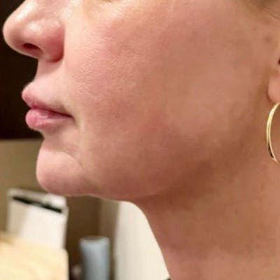 Junera Before & After Gallery - Patient 395201 - Image 2