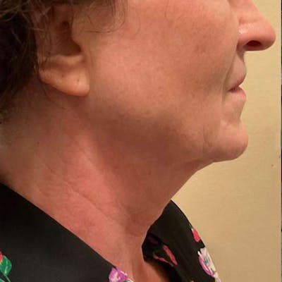 Junera Before & After Gallery - Patient 243506 - Image 1