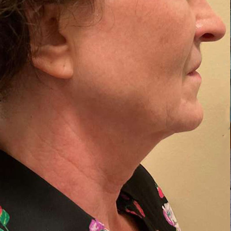 Junera Before & After Gallery - Patient 243506 - Image 1
