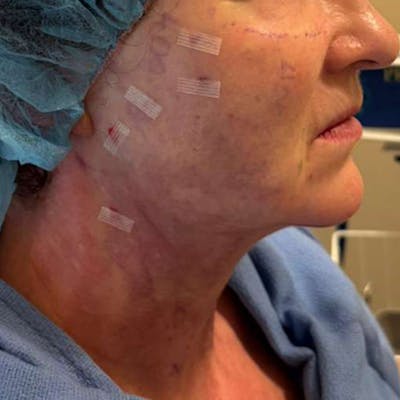 Junera Before & After Gallery - Patient 243506 - Image 2