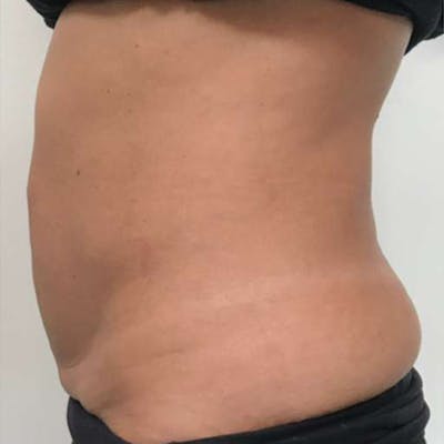 Junera Before & After Gallery - Patient 354122 - Image 1