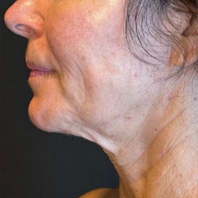 Junera Before & After Gallery - Patient 417972 - Image 1