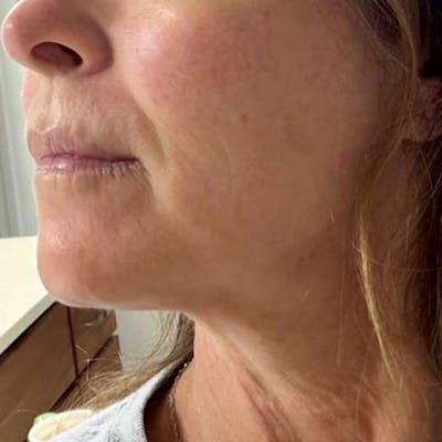 Junera Before & After Gallery - Patient 417972 - Image 2