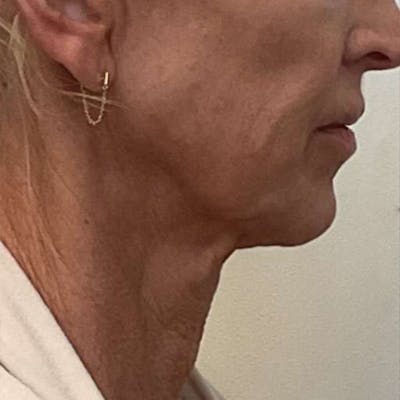 Junera Before & After Gallery - Patient 348206 - Image 1