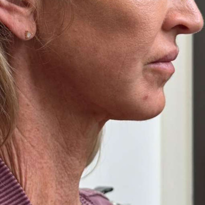 Junera Before & After Gallery - Patient 348206 - Image 2