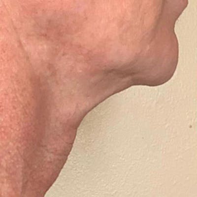 Junera Before & After Gallery - Patient 355343 - Image 1