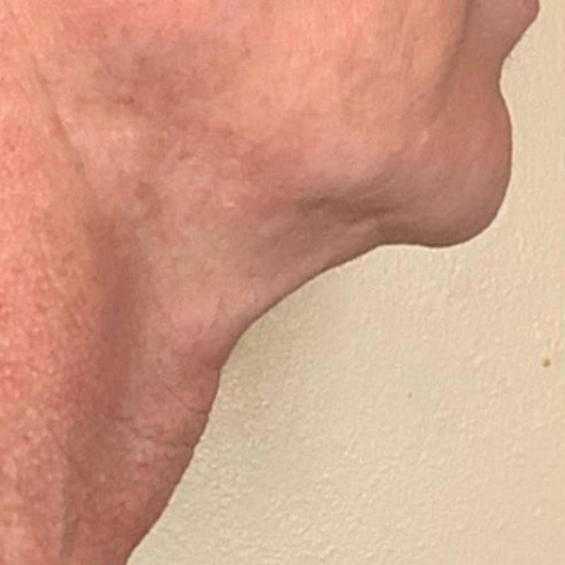 Junera Before & After Gallery - Patient 355343 - Image 1
