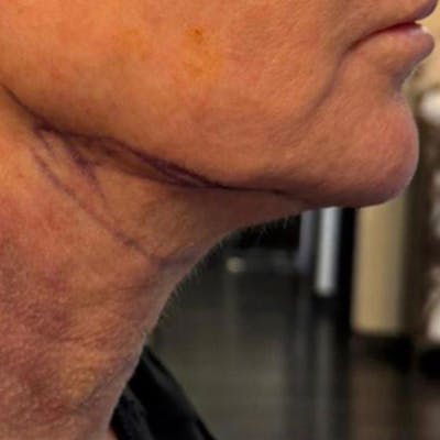 Junera Before & After Gallery - Patient 355343 - Image 2