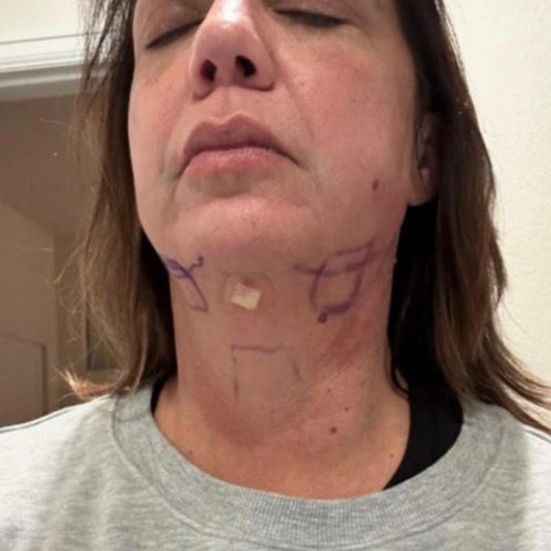 Junera Before & After Gallery - Patient 215326 - Image 4