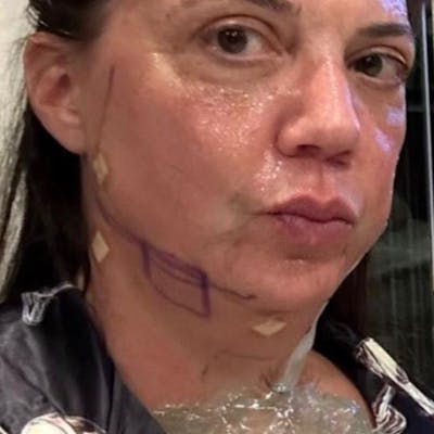 Junera Before & After Gallery - Patient 215326 - Image 2