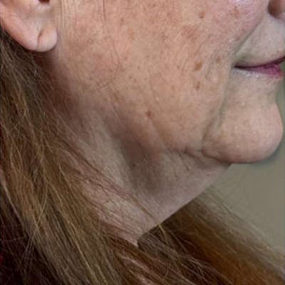 Junera Before & After Gallery - Patient 409239 - Image 1