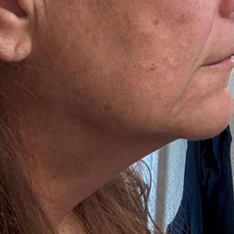 Junera Before & After Gallery - Patient 409239 - Image 2