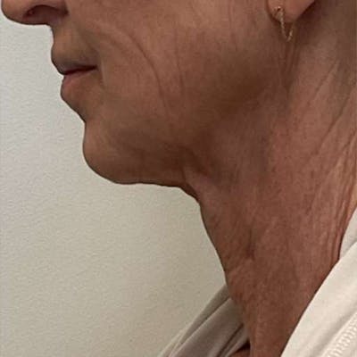 Junera Before & After Gallery - Patient 366256 - Image 1