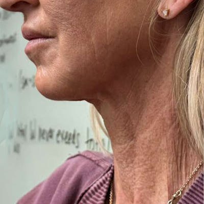 Junera Before & After Gallery - Patient 366256 - Image 2