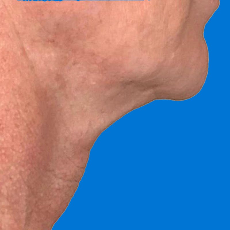 Junera Before & After Gallery - Patient 125237 - Image 1