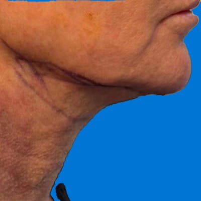 Junera Before & After Gallery - Patient 125237 - Image 2
