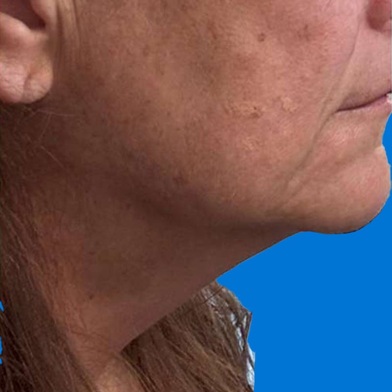Junera Before & After Gallery - Patient 366575 - Image 2