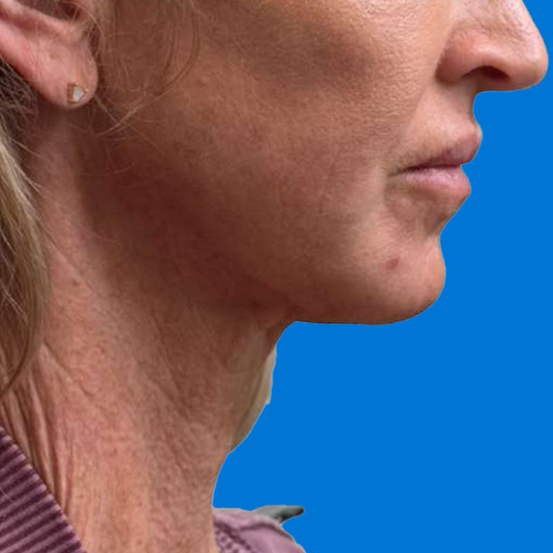 Junera Before & After Gallery - Patient 217508 - Image 2