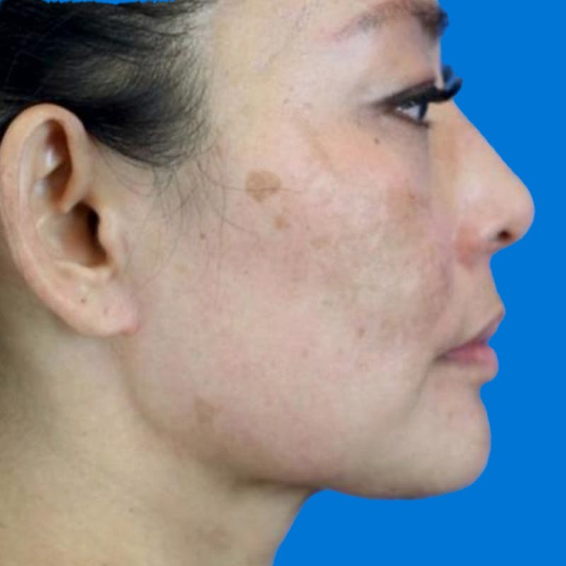 Junera Before & After Gallery - Patient 339735 - Image 1