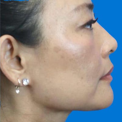 Junera Before & After Gallery - Patient 339735 - Image 2