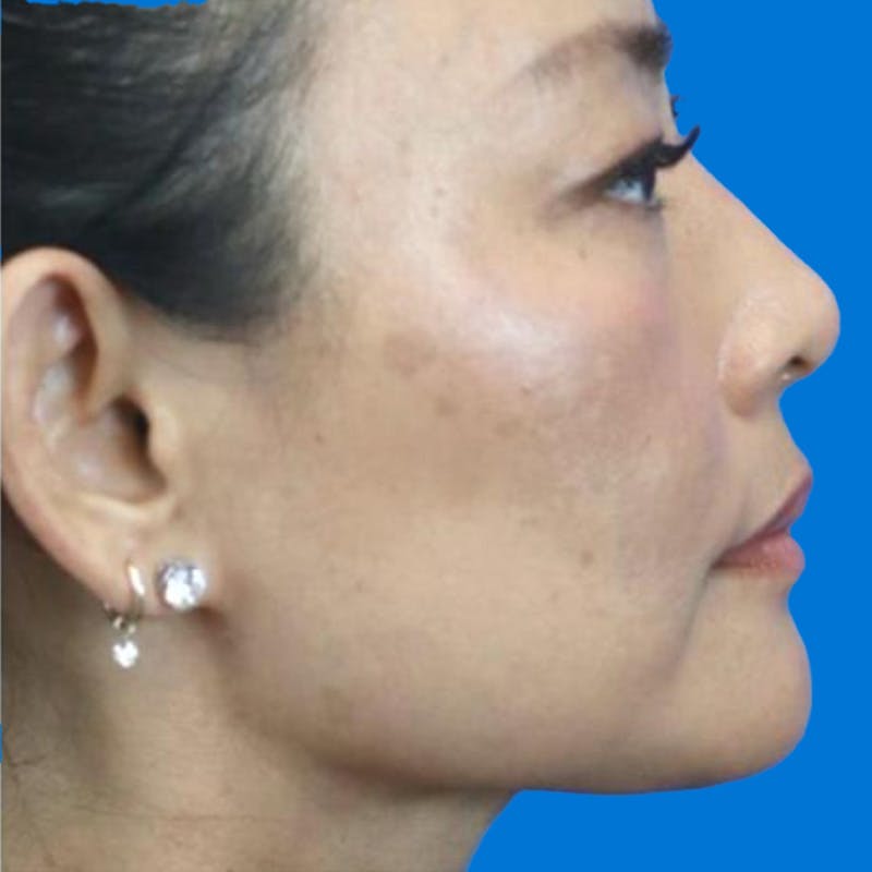 Junera Before & After Gallery - Patient 339735 - Image 2