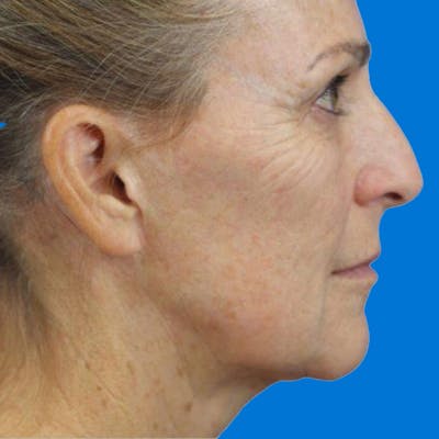 Junera Before & After Gallery - Patient 236588 - Image 1
