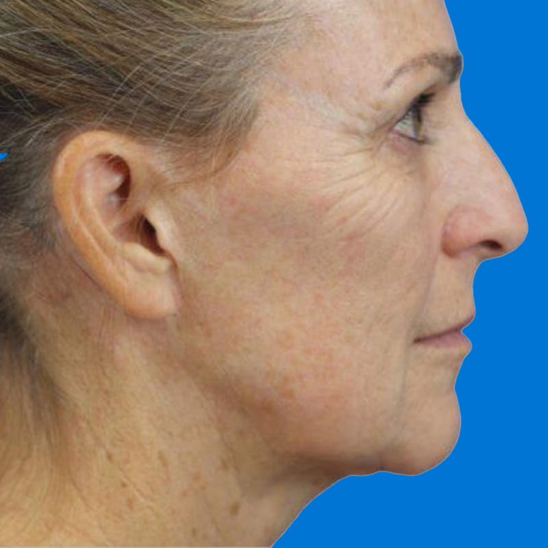 Junera Before & After Gallery - Patient 236588 - Image 1