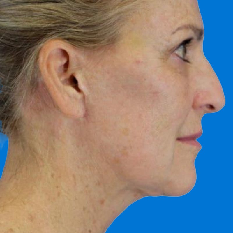 Junera Before & After Gallery - Patient 236588 - Image 2